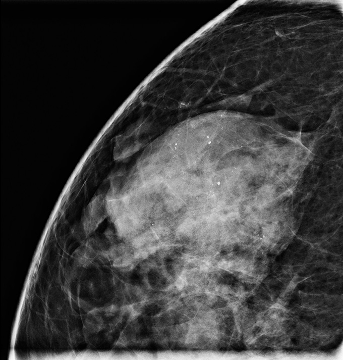 A mammogram of a breast with dense tissue and ductal carcinoma in situ, also called stage 0 breast cancer. DCIS appears as small white spots.